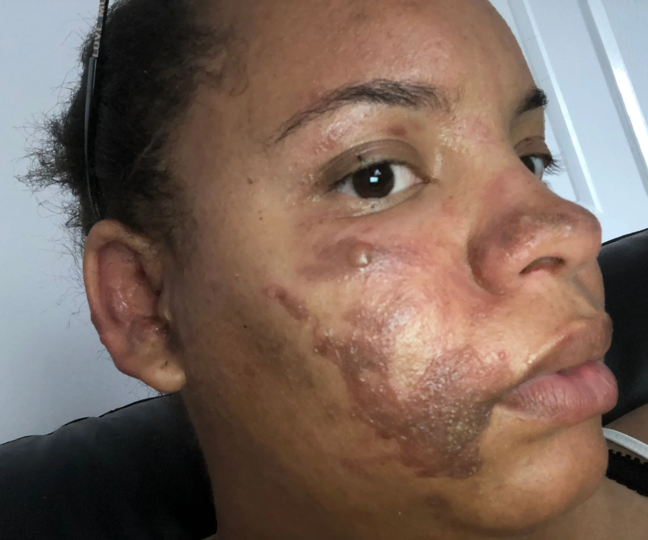 Scarred and blistered from the piping hot pie