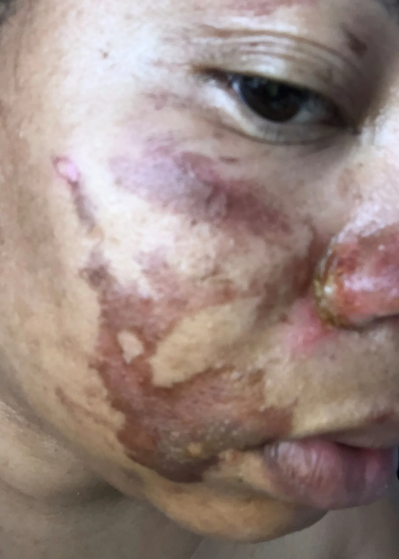 My burns after the pie attack