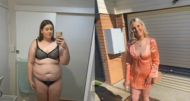 I Had a Gastric Sleeve at 17
