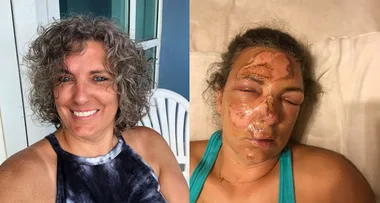 Mum’s Horror: I Fell Into Our BBQ!
