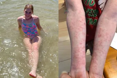 My Girl Is Allergic To The Sun