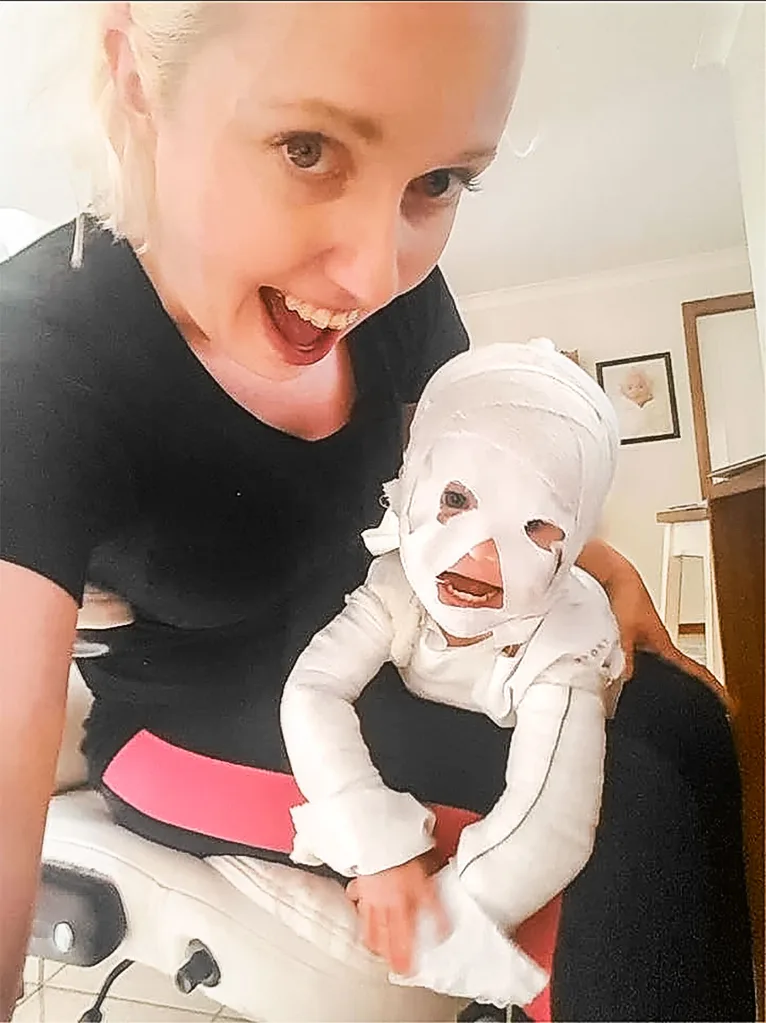 Caleb in all his bandages looks like a mummy