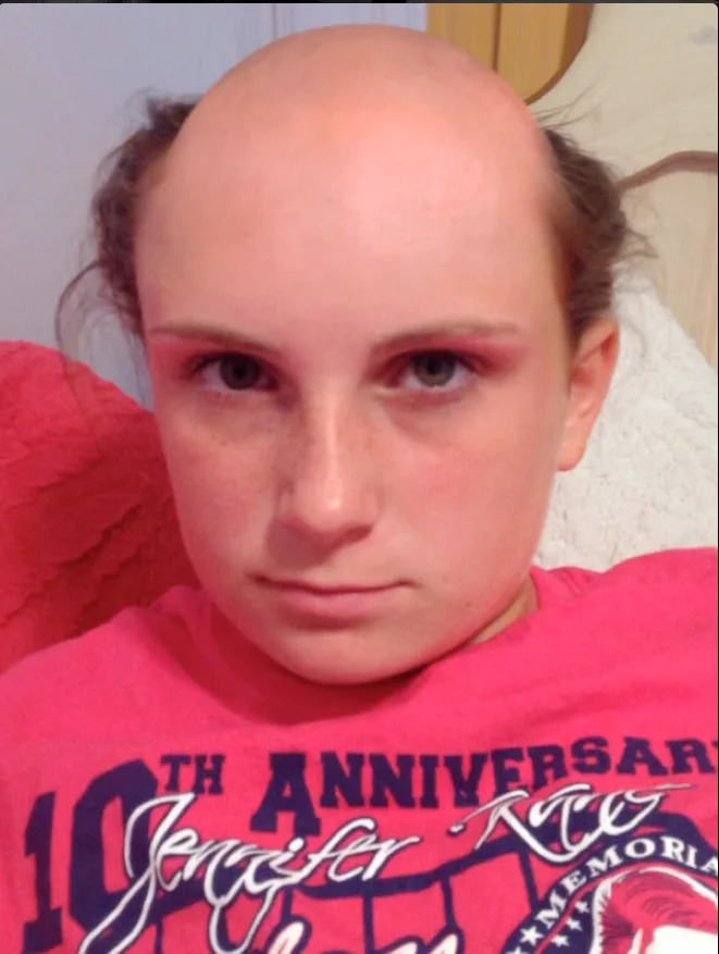 Woman who confused nair with shampoo