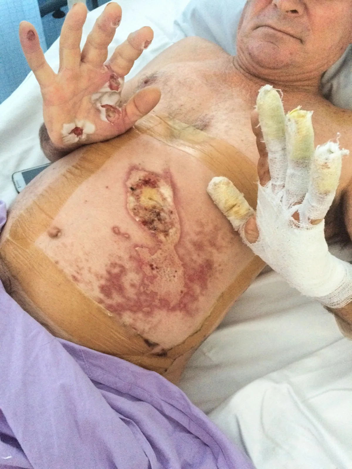 The electricity left Philip with severe burns.