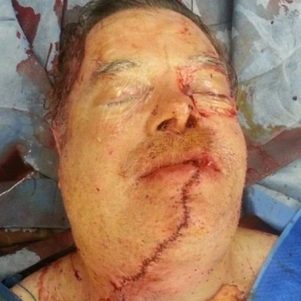 Me after surgery