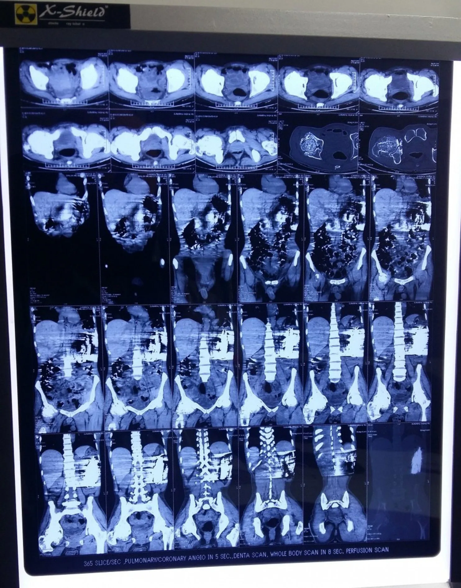 CT scan showing knives in patients stomach
