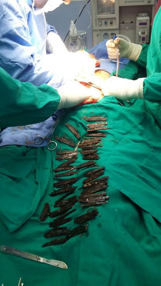 The knives were removed from the man's stomach one by one.