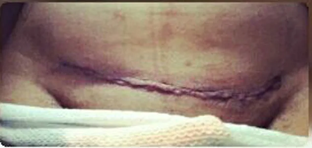 Kaye Lee posted an image of the c-section scar
