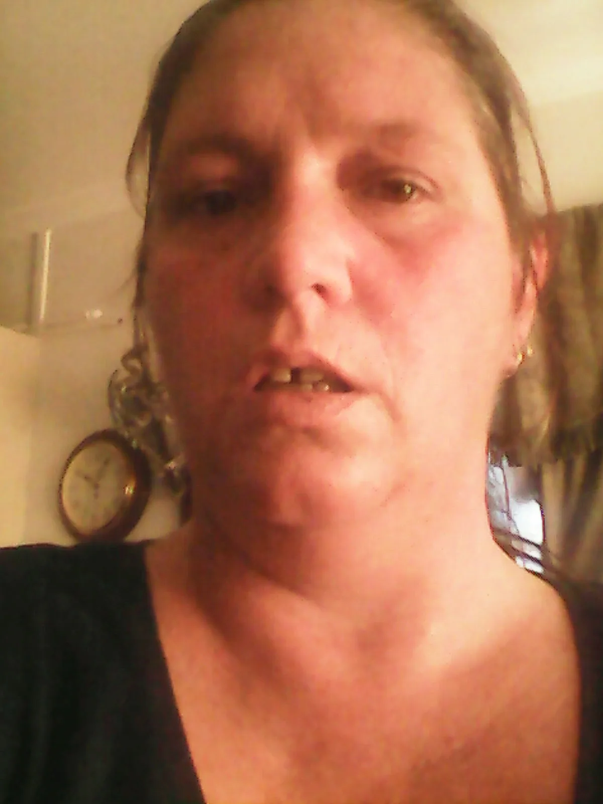 Katherine with aquagenic urticaria reaction on her face.