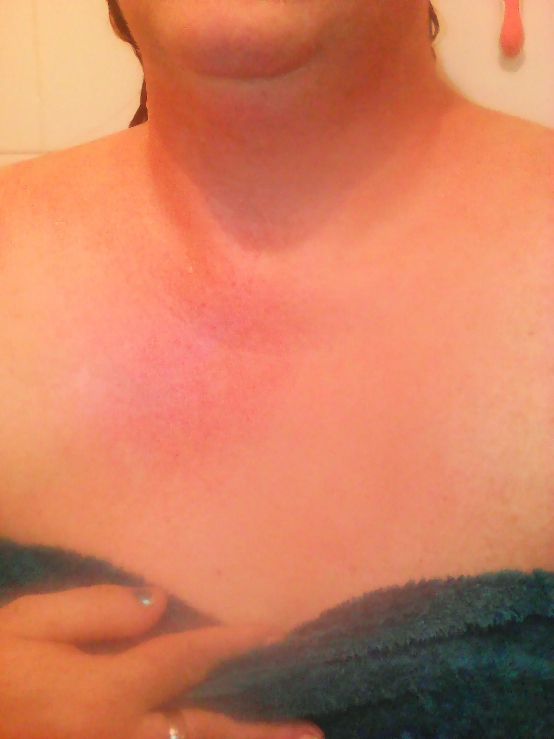 Katherin's aquagenic urticaria on her neck