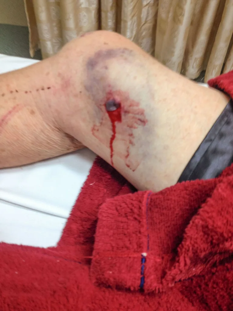 Maurice was stabbed in the leg with a stake.