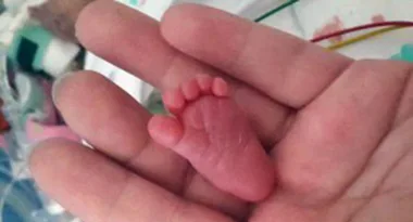 She is thought to be the smallest baby ever to survive a premature birth
