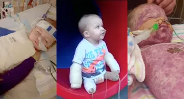Boy loses all four limbs to meningococcal disease