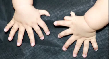 Incredible surgery to help baby born with 16 fingers and 15 toes
