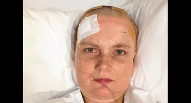 Awake as doctors drilled a hole in my head