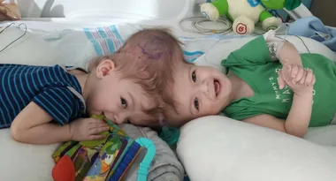 Conjoined twins undergo marathon surgery to separate them