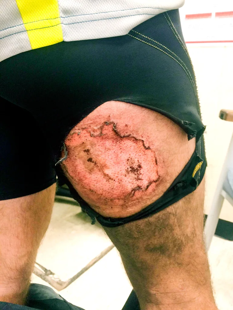The phone burned through the shorts