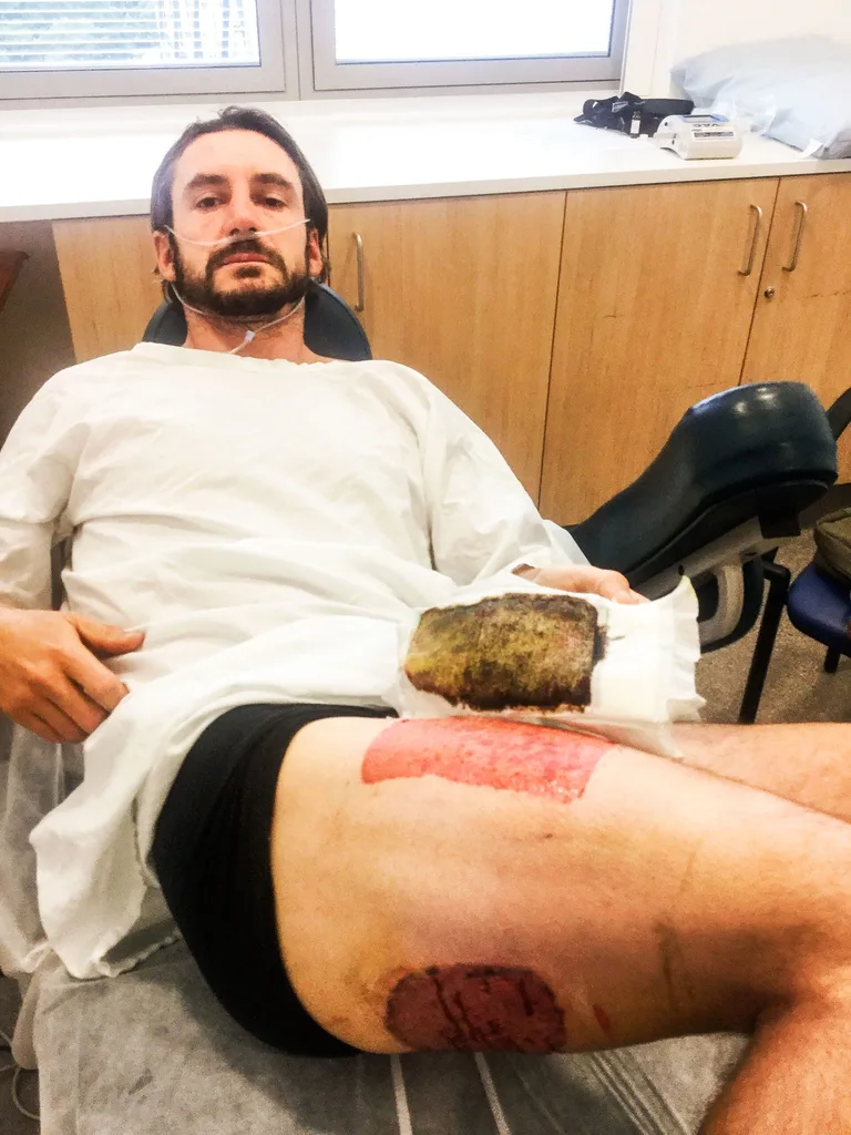 Thankfully the skin graft was a success