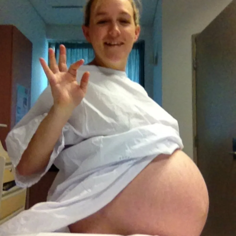 Kimberlee King pregnant with triplets which caused diastasis recti
