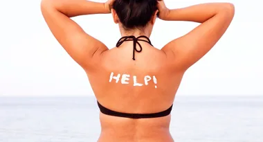 What to do when the Aussie summer leaves you burned and blistered!