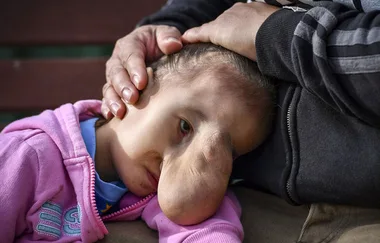 Four-year-old girl flown to Australia for treatment of her rare facial hernia