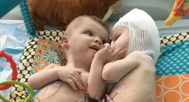 Twins conjoined at the head finally cuddle while recovering from surgery