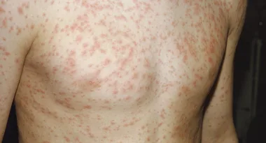 Sydneysiders warned over measles outbreak