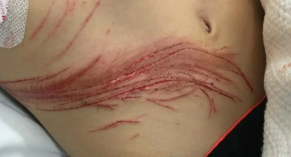 The injuries to Bradley's stomach