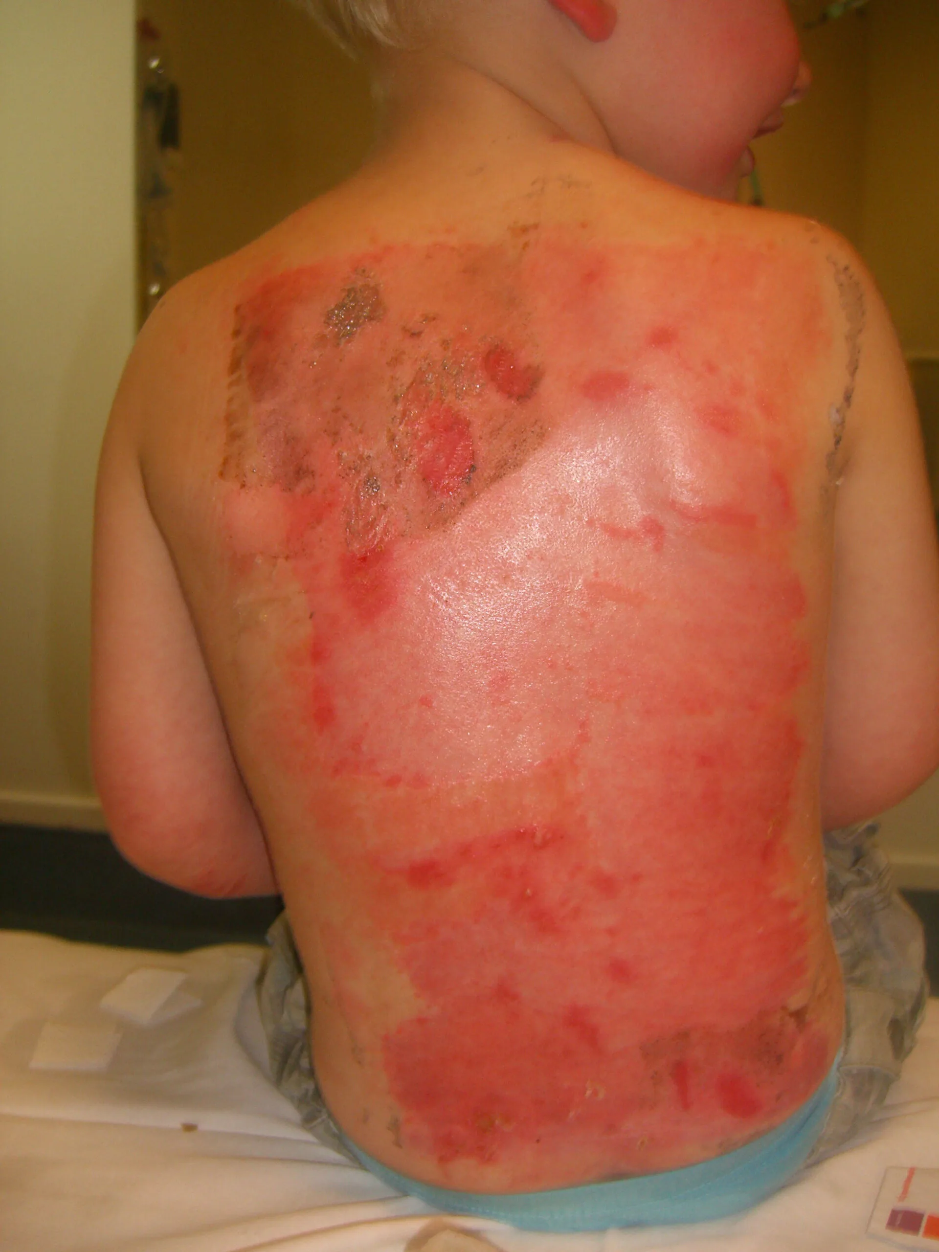 skin graft