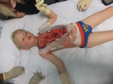 Microwave horror: toddler left with massive burns from scalding water
