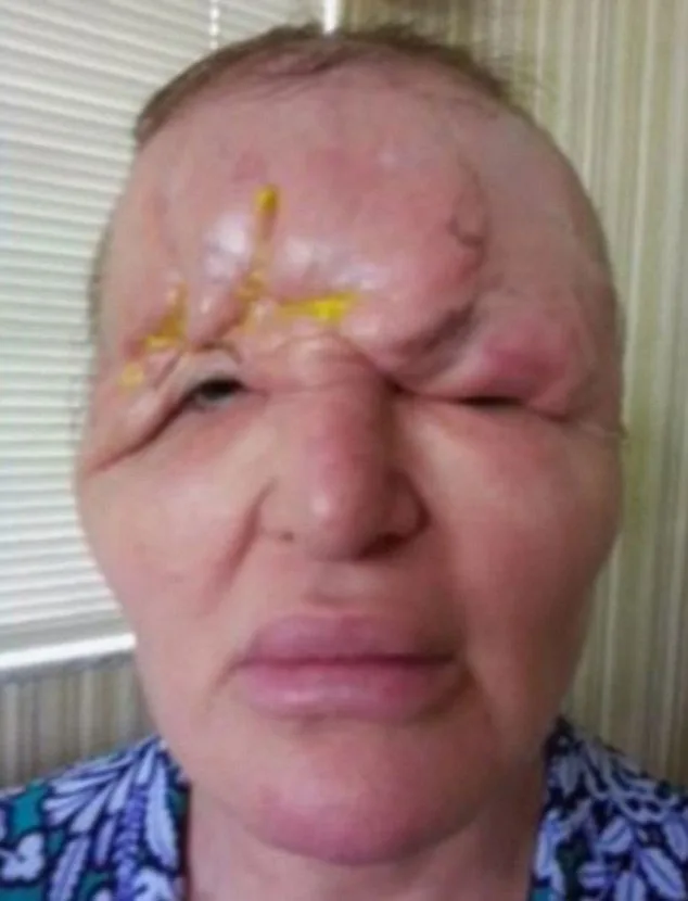 Carol after corrective surgeryu