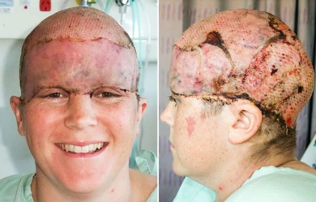 her scalp was reconstructed with skin grafts
