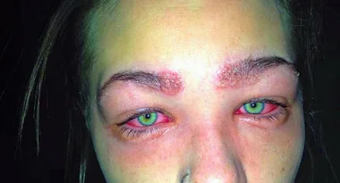 Woman suffers horrific allergic reaction when she tints her eyebrows