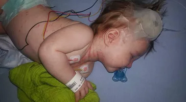 Chilling pics show how this baby boy’s meningitis rash started with just a few dots