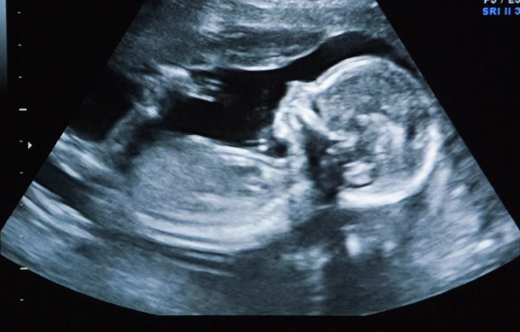 Fetus