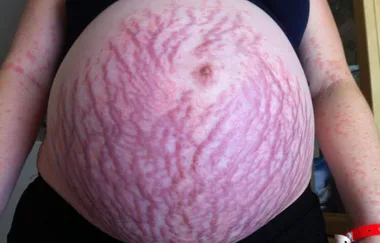 Pregnant woman’s rash covers her entire body