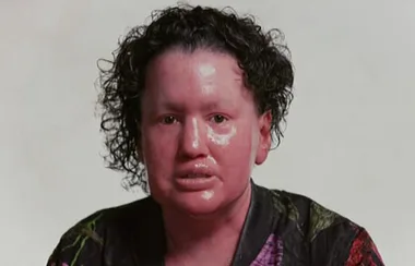 People with facial differences share their heartbreaking stories
