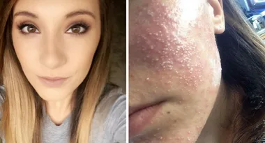 Woman contracts a staph infection after getting false lashes