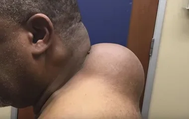 Man gets huge ‘bowling ball’ sized lump extracted from his neck