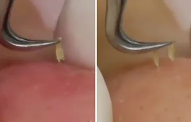 Blackhead removal video has us mesmerised