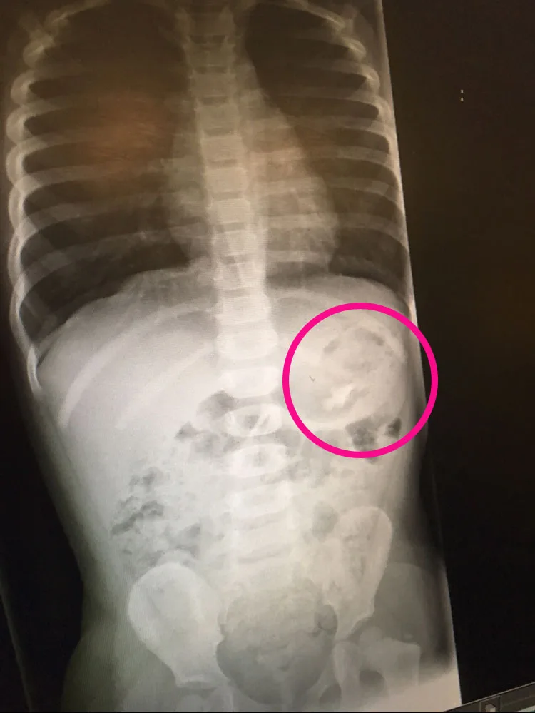 Eloise's x-ray
