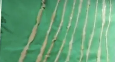 Little girl has two-metre tapeworm removed after eating sushi