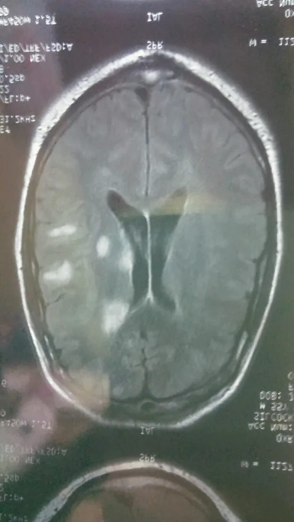 Lesions on Milton Silcock's brain