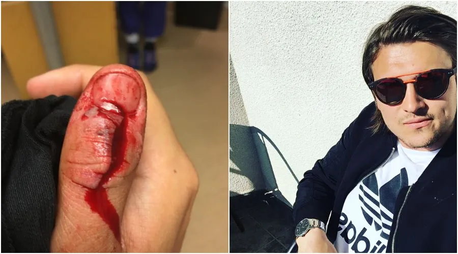 Alexander D&ouml;gl fractured his thumb and damaged ligaments when a fidget spinner exploded.