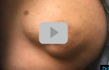 Dr Pimple Popper’s latest video is one of the most surprising and gruesome yet