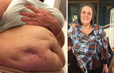 Mum’s warning after bungled colonic causes agonising injuries