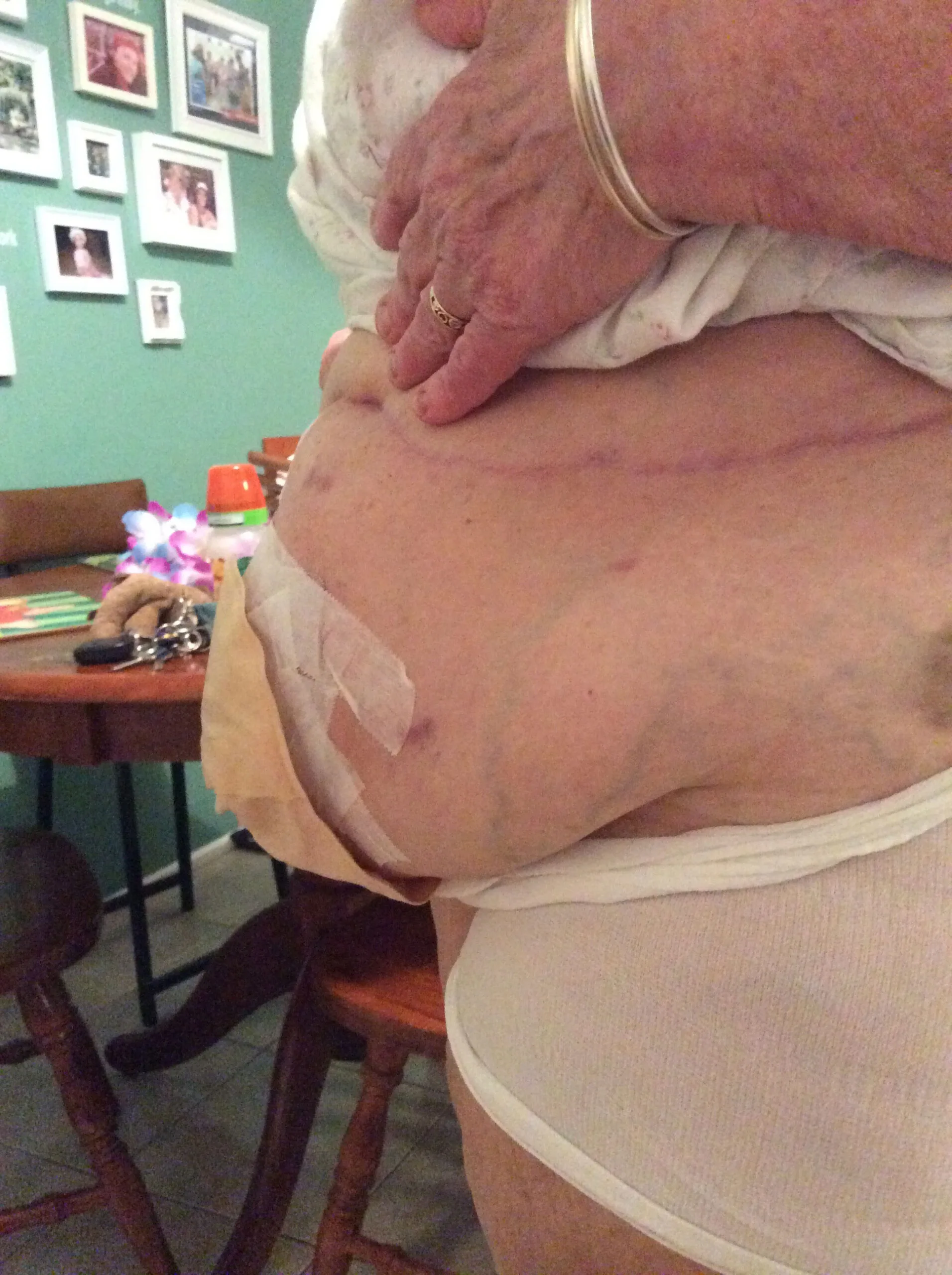 Pamela Kilah's stoma