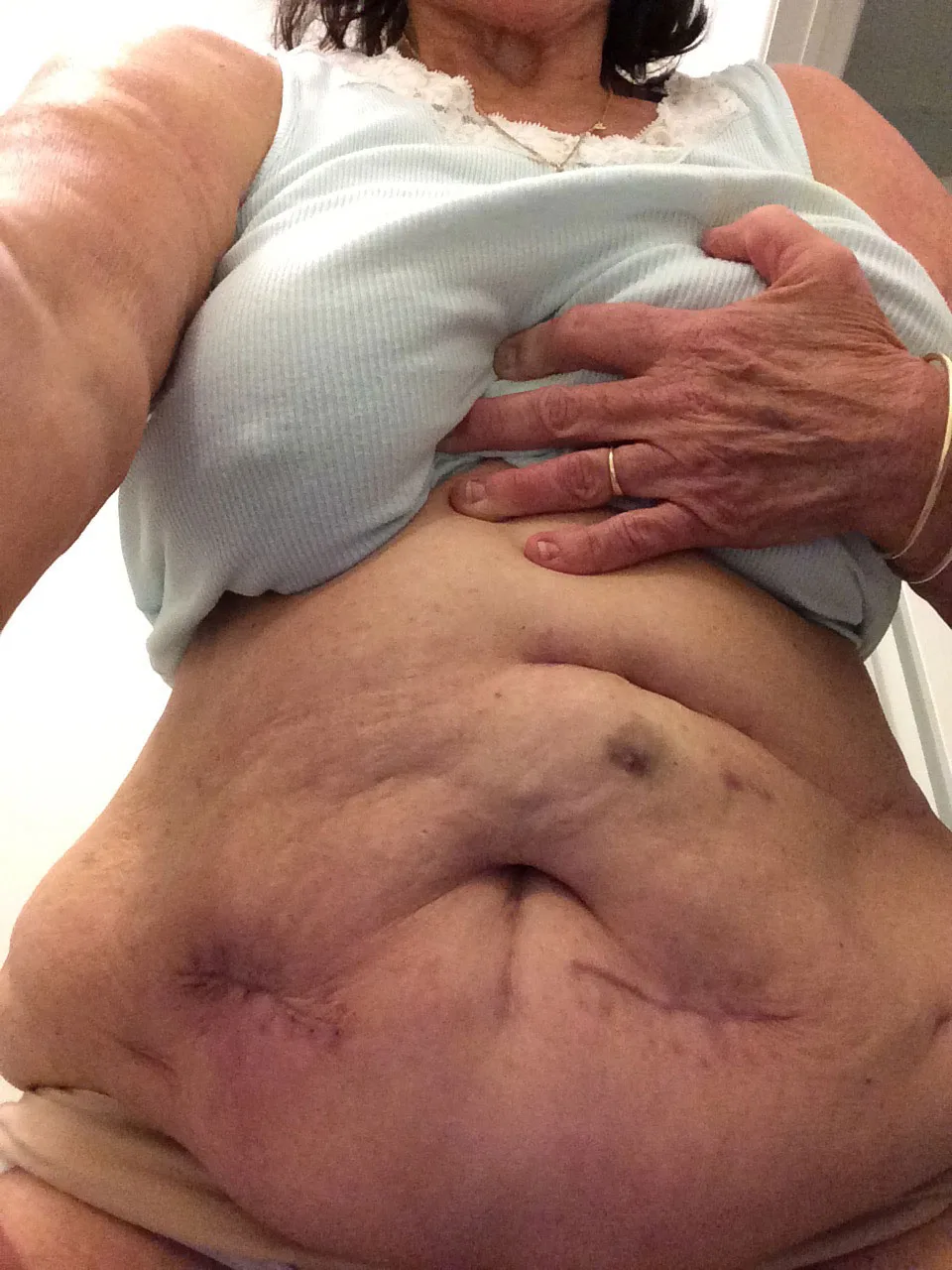 Pamela Kilah was left with upset scars