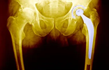 Investigation launched into ‘toxic’ hip replacements