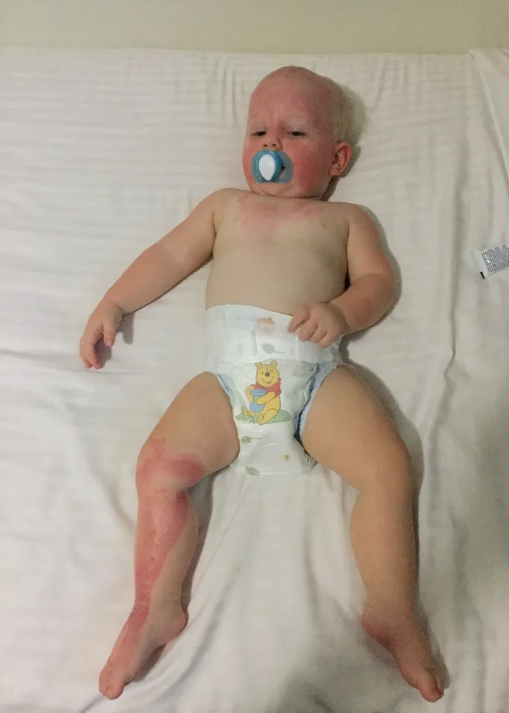 Hunter today - he will need more surgeries as he grows